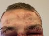 MMA fighters look unrecognisable after savage bloodbath with faces swollen and stitches in eyelids