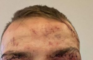 MMA fighters look unrecognisable after savage bloodbath with faces swollen and stitches in eyelids
